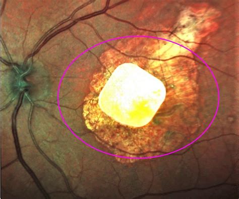 rfid chip in eye lazer|Implanted chip, natural eyesight coordinate vision in study of .